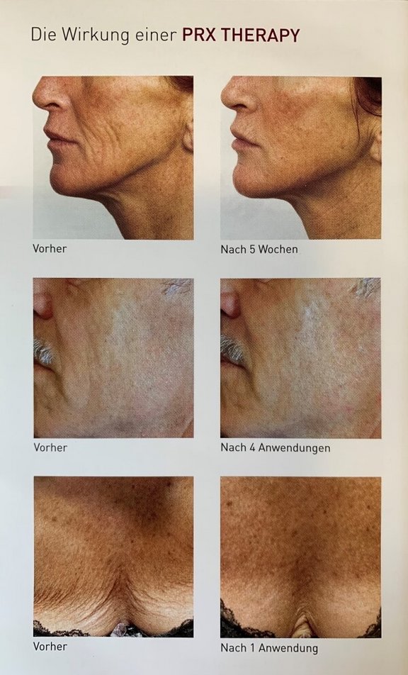 prx-t33-tca-peeling.jpg