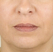 faltenbehandlung_teosyal_filler2_nachher.jpg